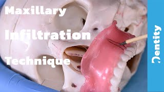 Maxillary Infiltration Technique  شرح عملي [upl. by Lancey158]