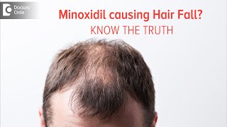 KNOW THE TRUTH  Does Minoxidil Solution cause Hair Fall Dr Deepak P Devakar  Doctors Circle [upl. by Bahr776]