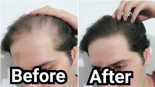 How I Grew Back my Hair with Rosemary Oil My Results w Pictures Before amp After  How To Use [upl. by Yelnik]