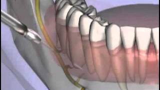 Malameds Local Anesthesia 11 Supplemental Injection Techniques [upl. by Ambie]