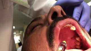 Palatal Anesthetic Infiltration Technique [upl. by Malliw]