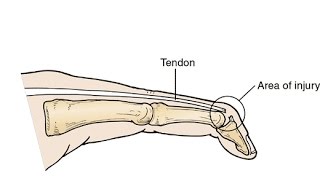 Greensboro Orthopaedics Mallet Finger Splint Application amp Removal with Jennifer Sexton OTRL CHT [upl. by Flin]